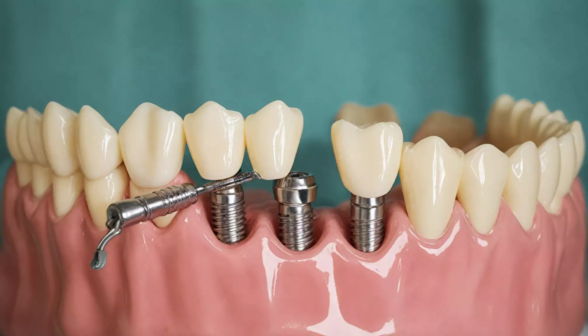 Ile kosztuje implant zęba u ortodonty vs chirurga?